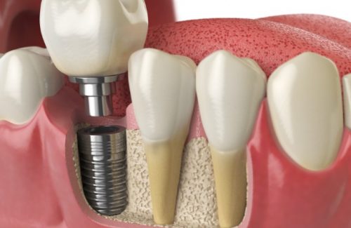 anatomy-of-healthy-teeth-and-tooth-dental-implant-2021-08-26-16-56-57-utc