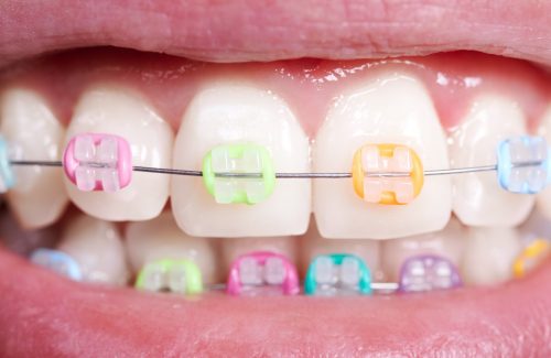 white-teeth-with-wired-orthodontic-brackets-2022-05-28-10-14-55-utc
